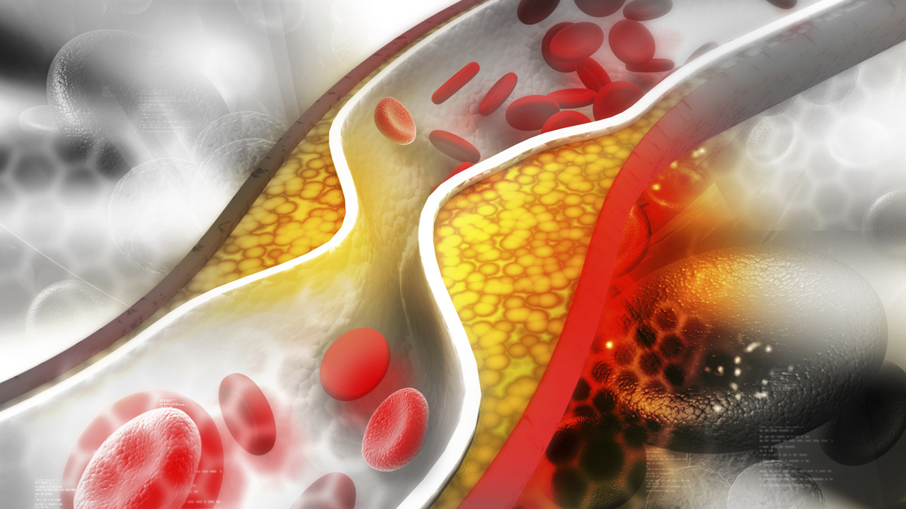 PCSK9 “đường uống” – bước tiến mới trong hạ LDL-C ở bệnh nhân tăng cholesterol máu